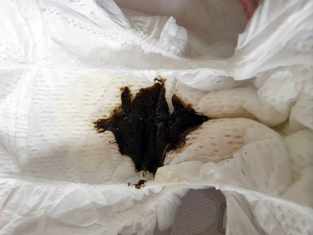 photo of black meiconium in a nappy