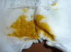 A nappy containing mustard coloured poo