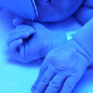 Featured Image for Treatment for Jaundice