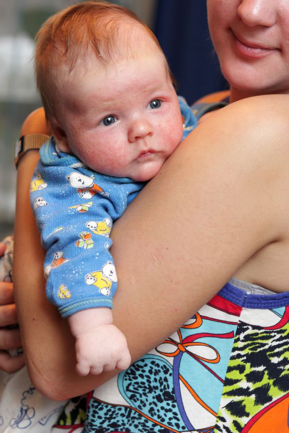 baby held in arms with eczema on face