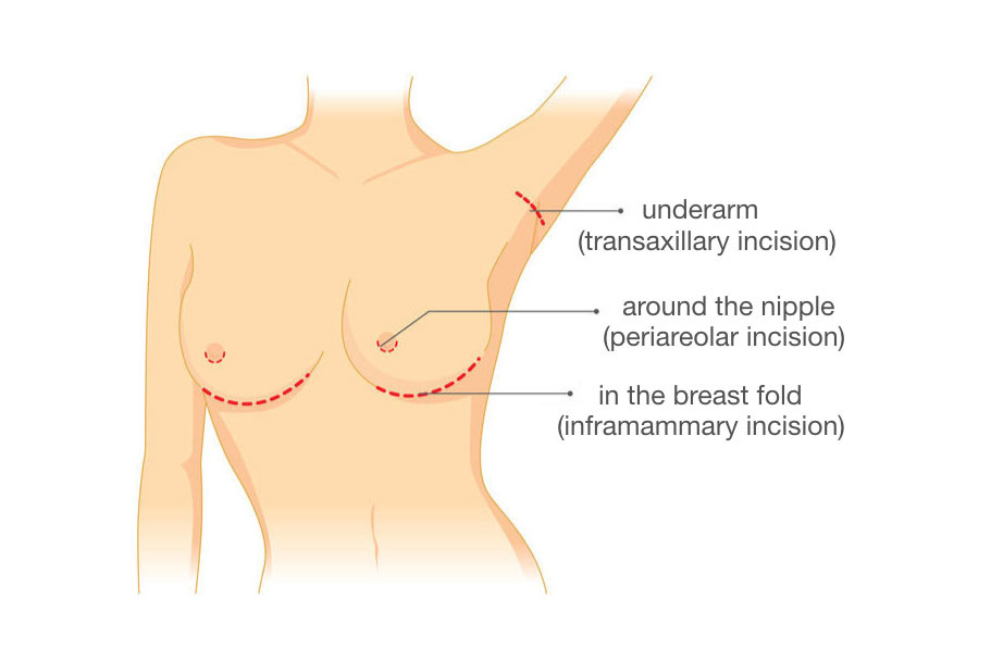 Breastfeeding with Breast Implants: What You Need to Know - Shelly