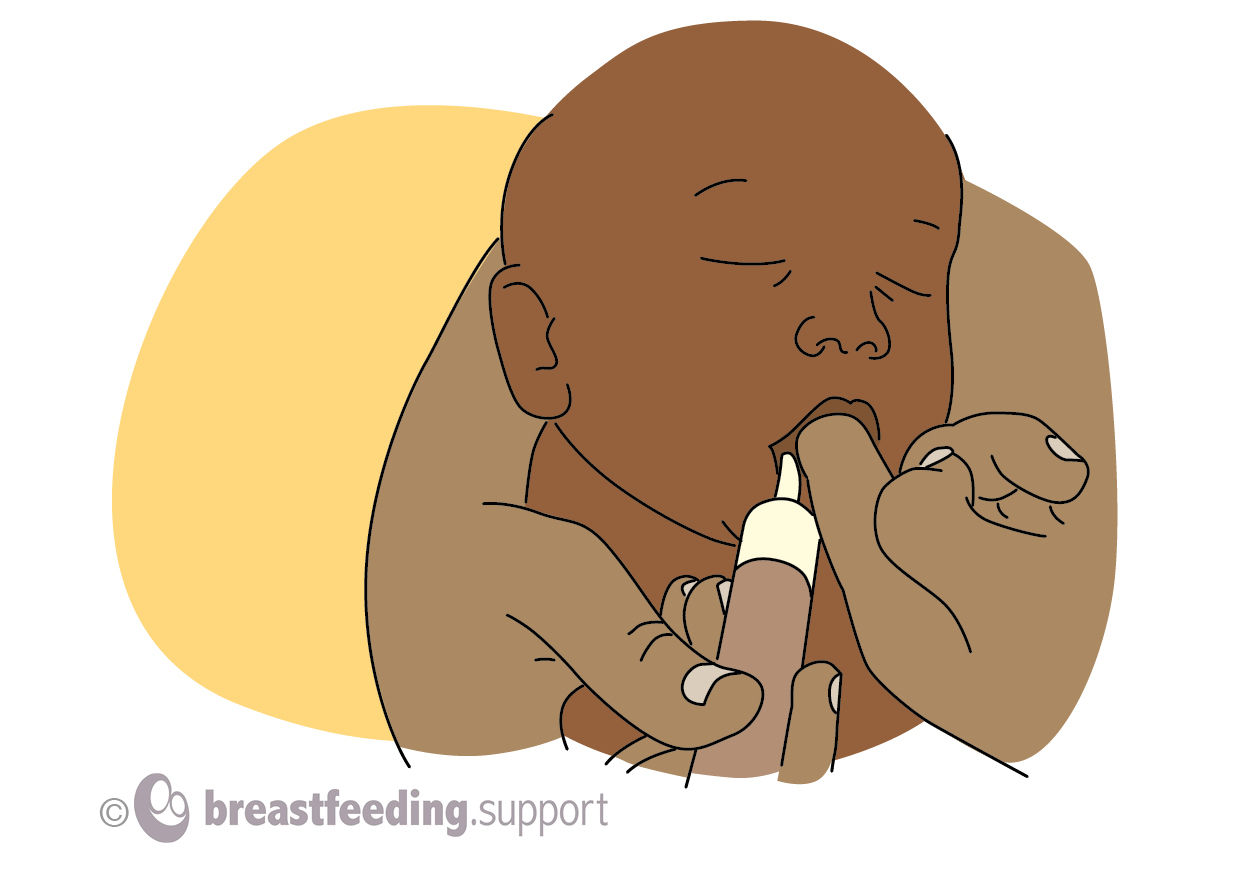 Drawing of a baby receiving milk from a curved tip syringe while finger feeding