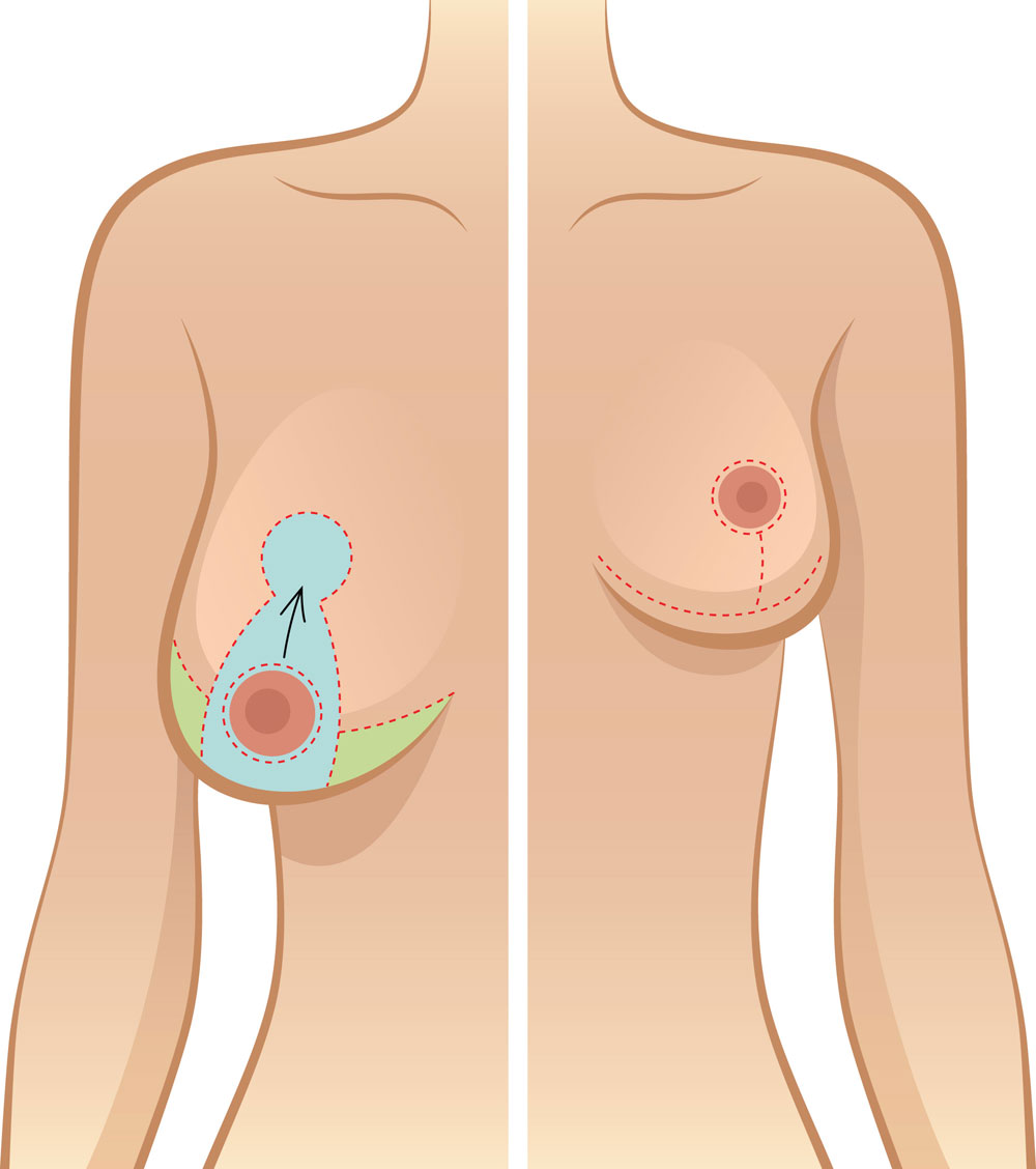 Periareolar Breast Reduction